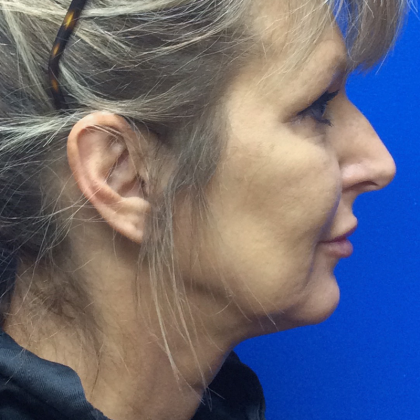 HourLift Before & After Patient #10179