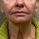 Neck Lift Before & After Patient #10182