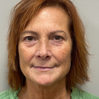 Mini Facelift Before & After Patient #10166