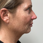 Revanesse Versa - Cheeks Before & After Patient #10194