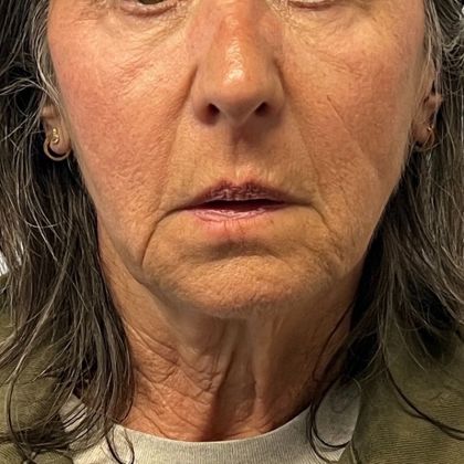 Neck Lift Before & After Patient #10203