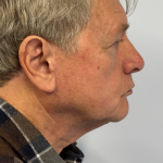 HourLift Before & After Patient #10208