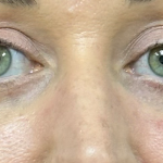 Blepharoplasty Before & After Patient #10173