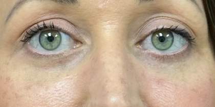 Blepharoplasty Before & After Patient #10173