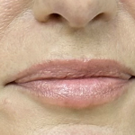 Pretty Lips Before & After Patient #10176