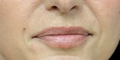 Pretty Lips Before & After Patient #10176