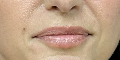 Revanesse Versa - Lips Before & After Patient #10176