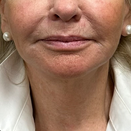 Neck Lift Before & After Patient #10182
