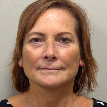 Mini Facelift Before & After Patient #10166