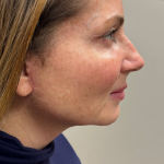 Revanesse Versa - Cheeks Before & After Patient #10194