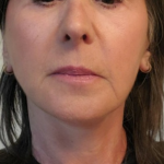 Neck Lift Before & After Patient #10203