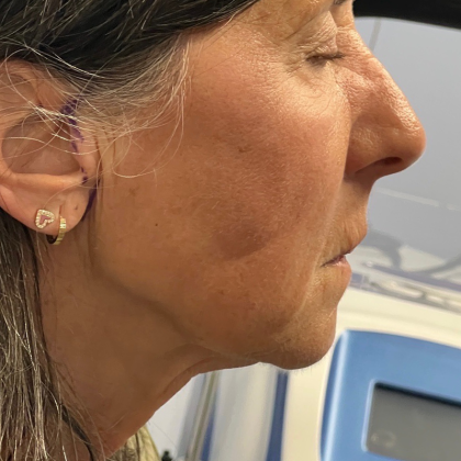 Neck Lift Before & After Patient #10203