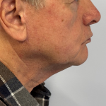 Neck Lift Before & After Patient #10213
