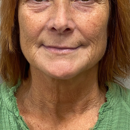 Neck Lift Before & After Patient #10171