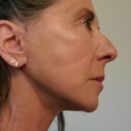 Midface Filler Before & After Patient #10197