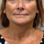 Neck Lift Before & After Patient #10171