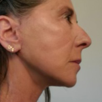Neck Lift Before & After Patient #10203