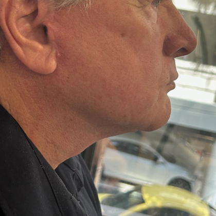 Neck Lift Before & After Patient #10213