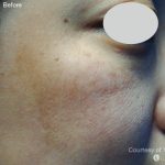 IPL for Pigment Before & After Patient #10306