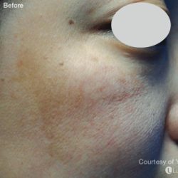 IPL for Pigment Before & After Patient #10306