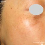 IPL for Pigment Before & After Patient #10309