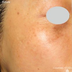 IPL for Pigment Before & After Patient #10309