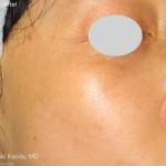 IPL for Pigment Before & After Patient #10309
