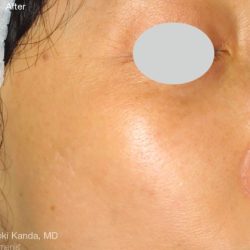 IPL for Pigment Before & After Patient #10309