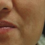 IPL for Pigment Before & After Patient #10310