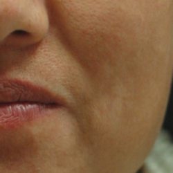 IPL for Pigment Before & After Patient #10310