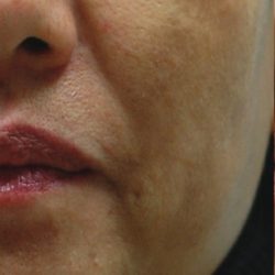 IPL for Pigment Before & After Patient #10310
