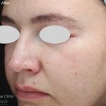 IPL for Pigment Before & After Patient #10311