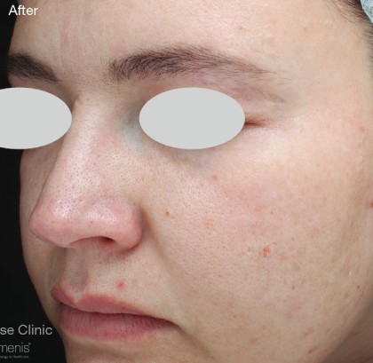 IPL for Pigment Before & After Patient #10311