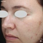IPL for Pigment Before & After Patient #10311