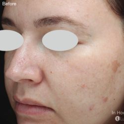 IPL for Pigment Before & After Patient #10311