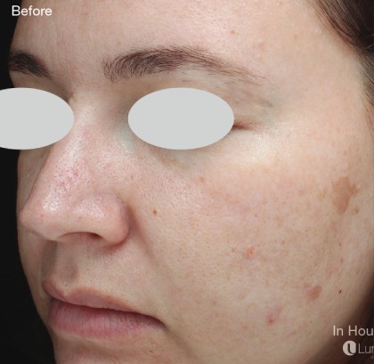 IPL for Pigment Before & After Patient #10311