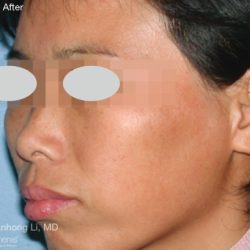 IPL for Pigment Before & After Patient #10312