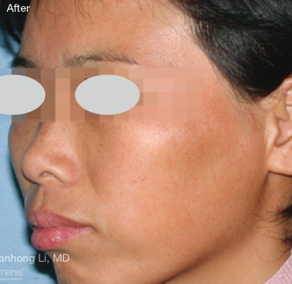 IPL for Pigment Before & After Patient #10312