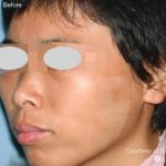 IPL for Pigment Before & After Patient #10312