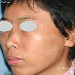 IPL for Pigment Before & After Patient #10312