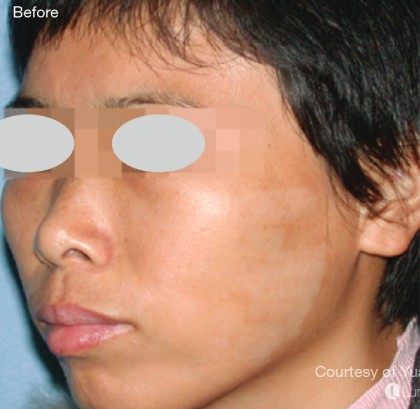 IPL for Pigment Before & After Patient #10312