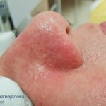 IPL for Veins Before & After Patient #10328
