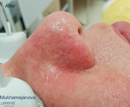 IPL for Veins Before & After Patient #10328