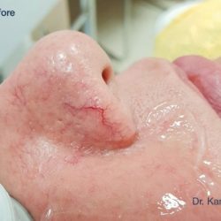 IPL for Veins Before & After Patient #10328