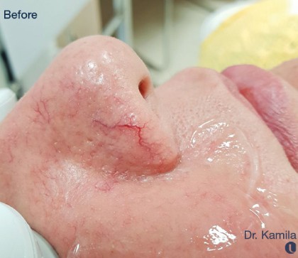 IPL for Veins Before & After Patient #10328