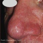 IPL for Veins Before & After Patient #10324