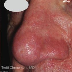 IPL for Veins Before & After Patient #10324