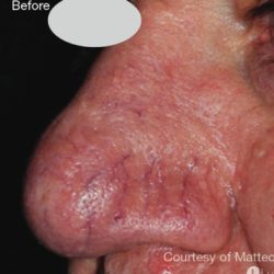 IPL for Veins Before & After Patient #10324