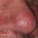 IPL for Veins Before & After Patient #10325