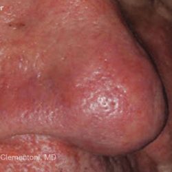 IPL for Veins Before & After Patient #10325